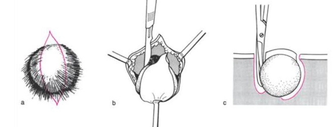 Atheroma