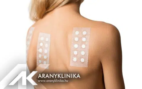 Új Epicutan teszt érhető el az Aranyklinikán!